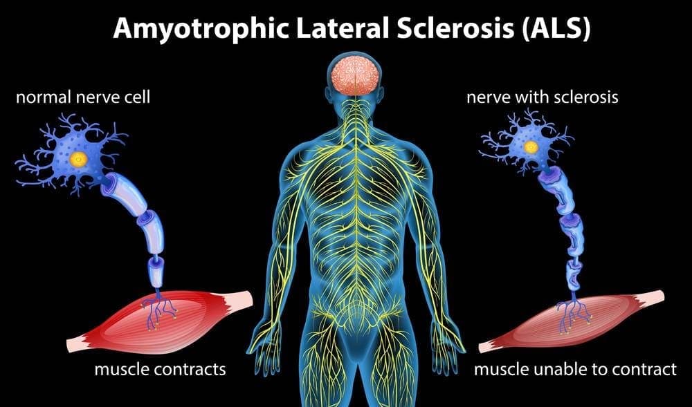 amyotrophic lateral sclerosis (ALS